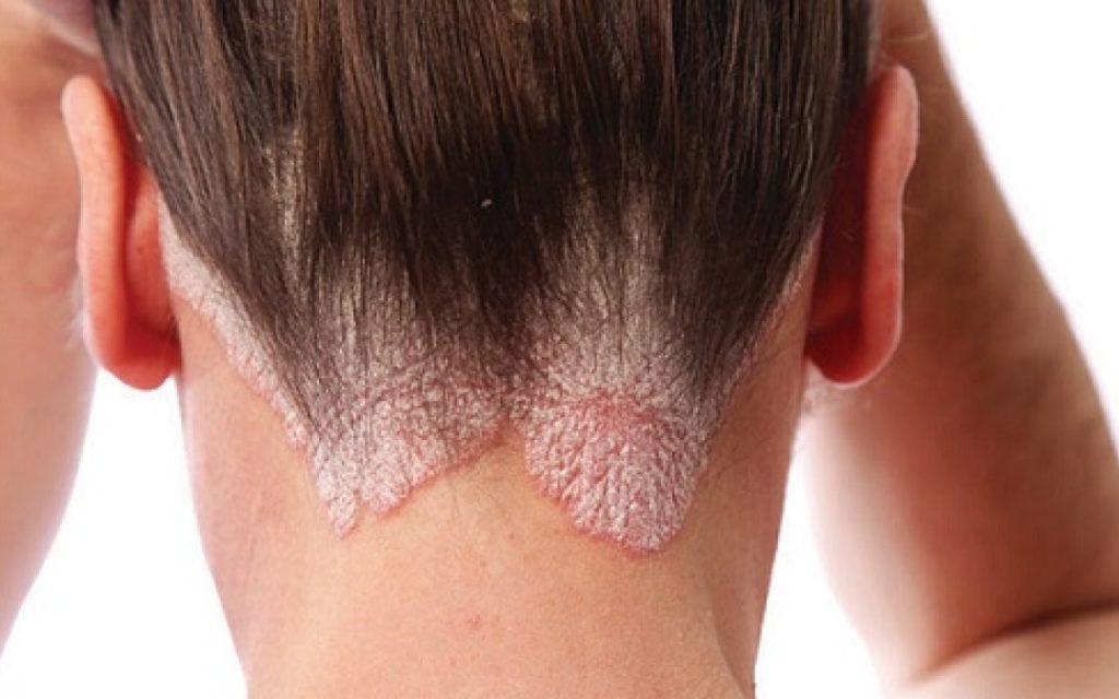 Cryotherapy is effective as a symptomatic treatment of psoriasis